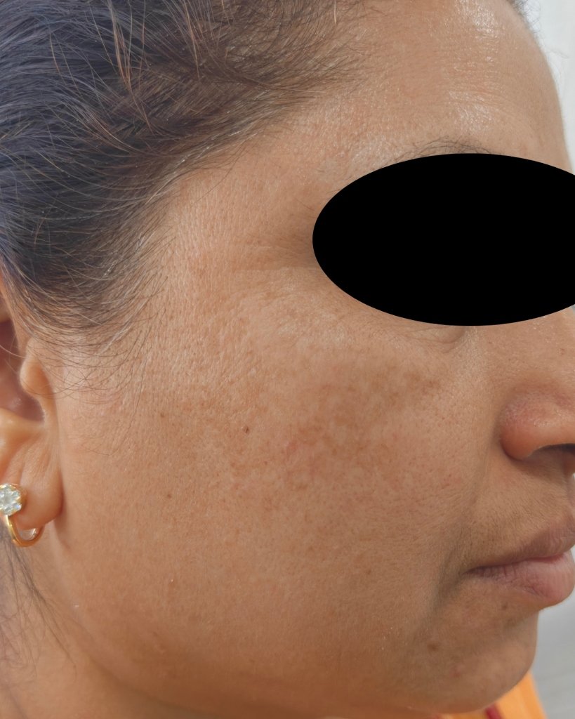 After (Clear Skin)