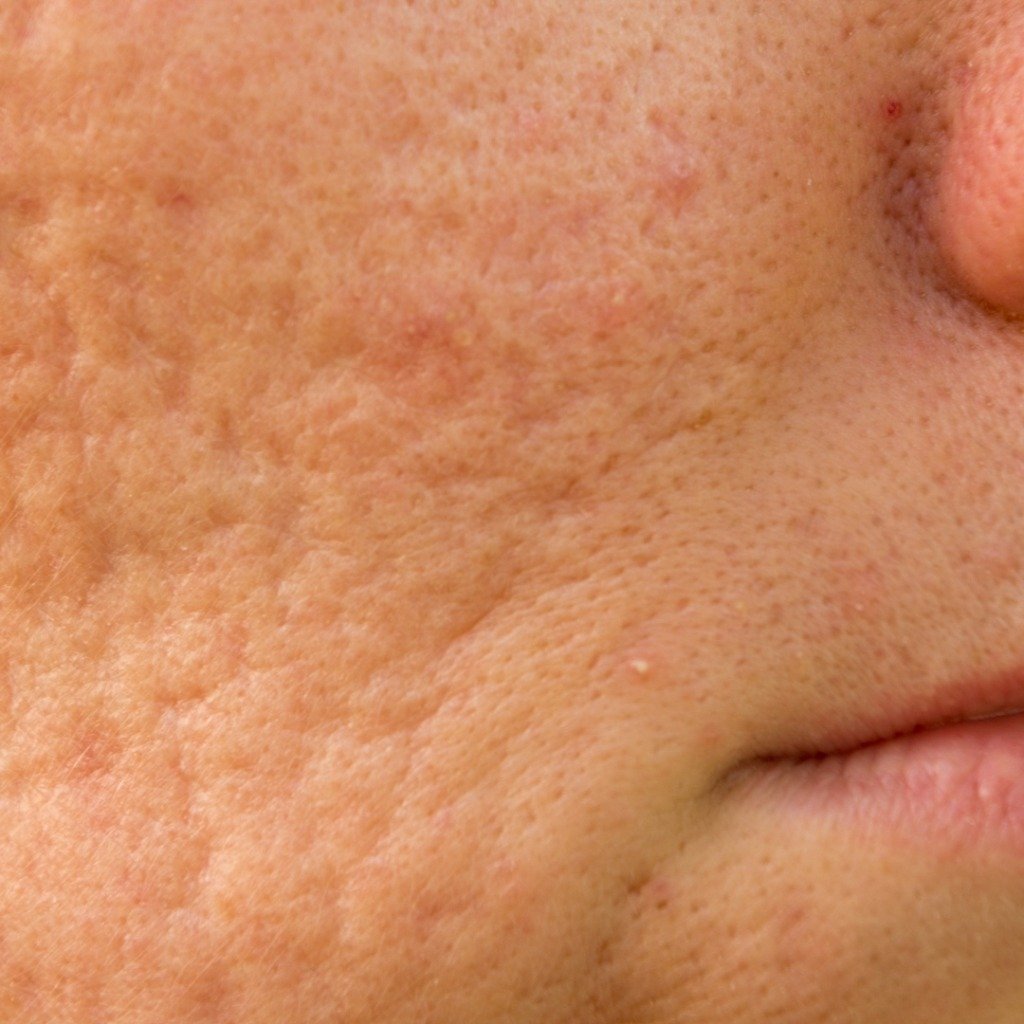 Acne Scar Treatment (Pitted Scars & Collagen Remodeling)