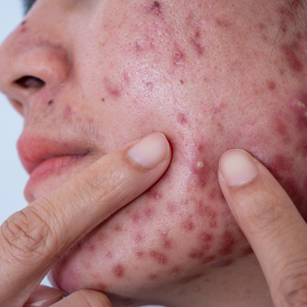 Acne Treatment (Active Breakouts & Pustules)
