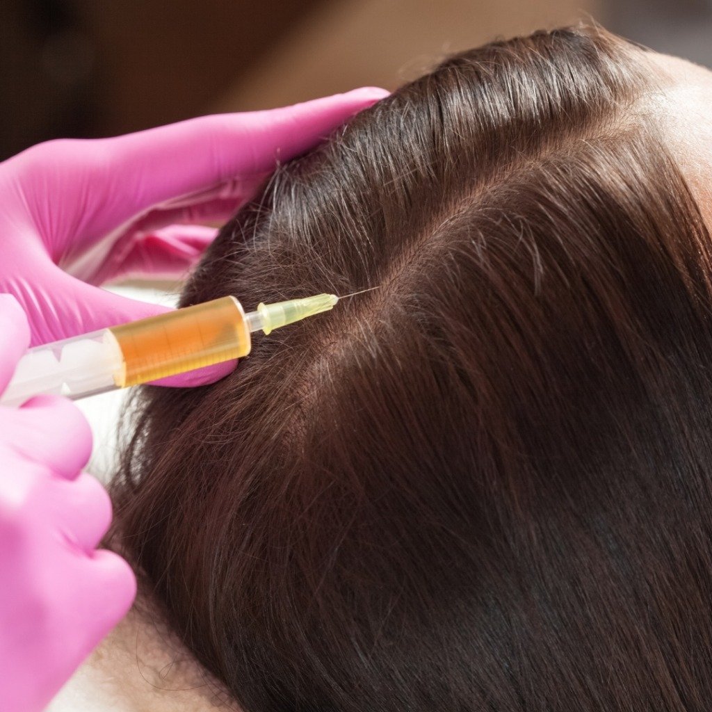 Autologous GFC & PRP Hair Restoration