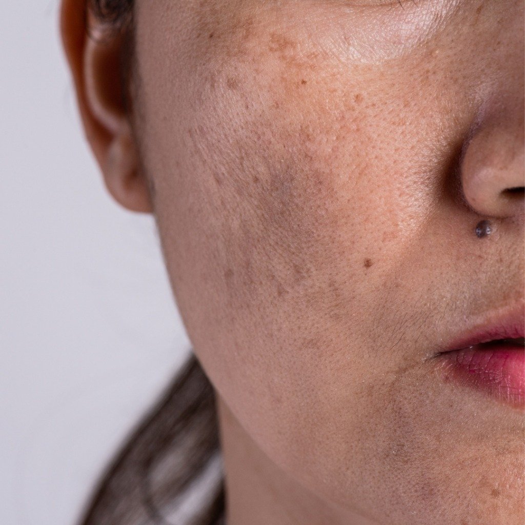 Melasma & Facial Hyperpigmentation
