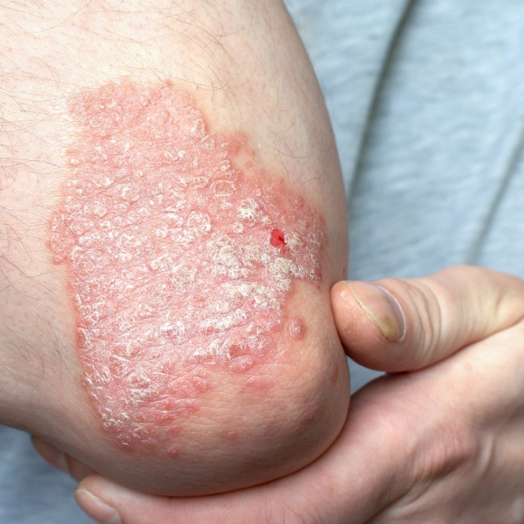 Psoriasis Vulgaris