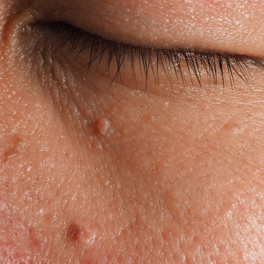 Radiofrequency (RF) Cautery for Warts, Moles & Skin Tags