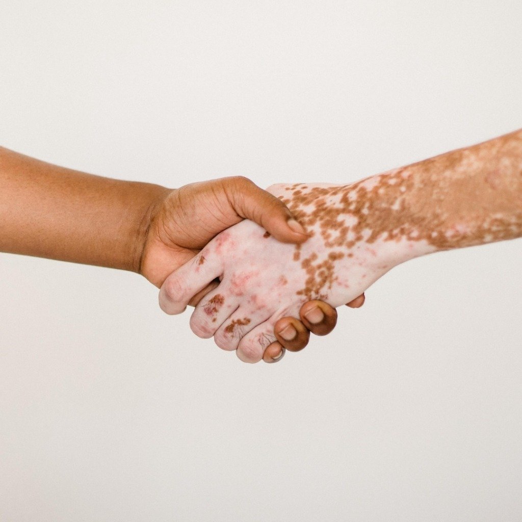 Vitiligo & Leukoderma